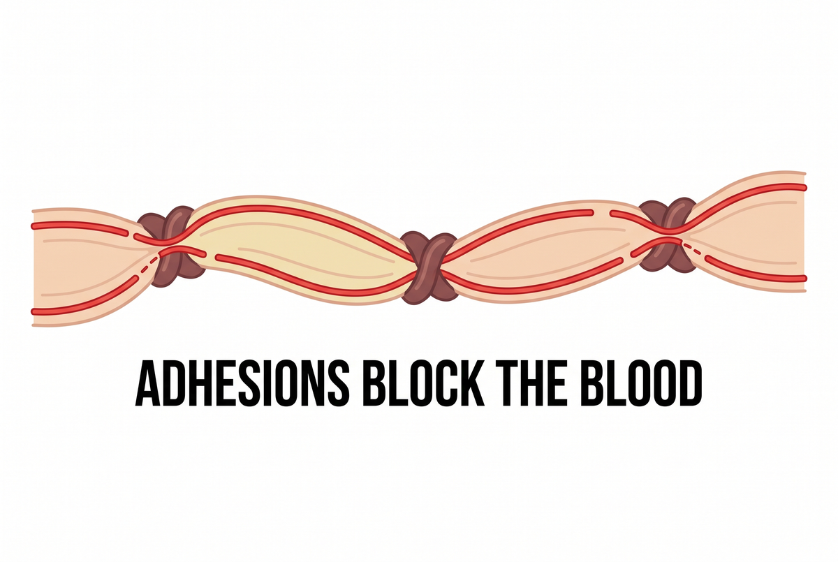 Adhesions in the fascia block the blood supply